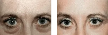 Blefaroplastica – prima e dopo