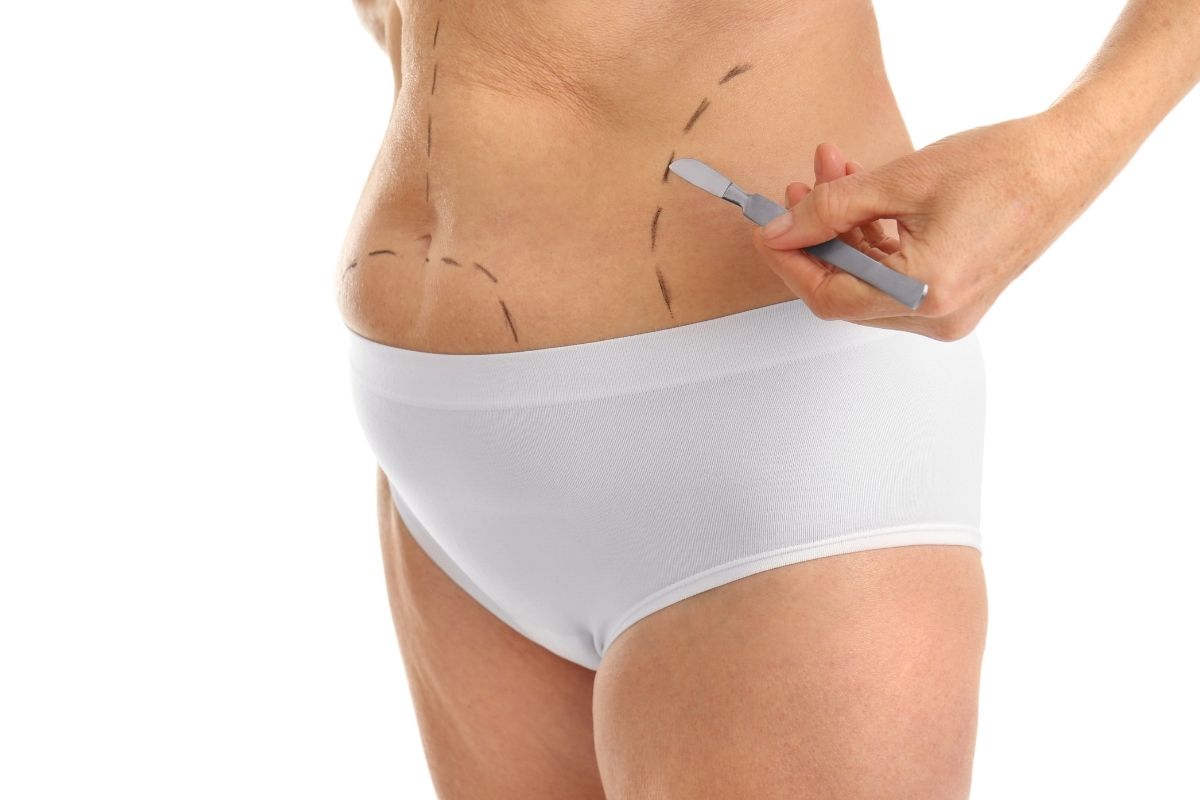 Lipoaspirazione
