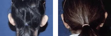 Otoplastica – prima e dopo