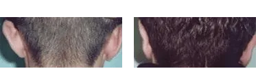 Otoplastica – prima e dopo