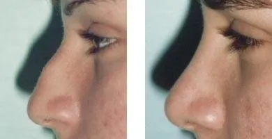 Rinoplastica – prima e dopo