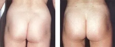 Lipoaspirazione – prima e dopo