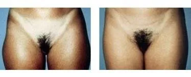 Lipoaspirazione – prima e dopo