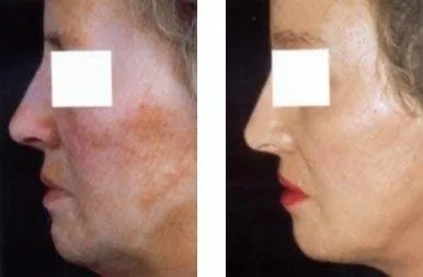 Peeling chimico – prima e dopo
